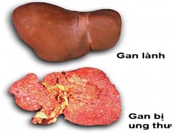 Ung thư gan thường xuất hiện âm thầm