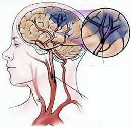 Phương pháp điều trị nhồi máu não bằng siêu âm