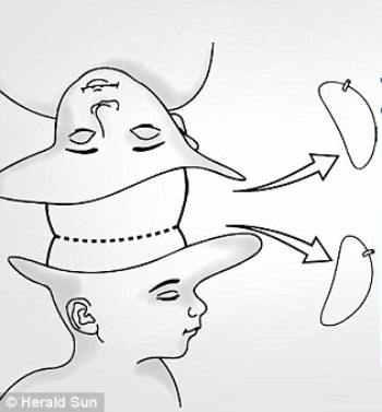 Kinh ngạc về ca phẫu thuật tách hai bé gái dính liền đầu
