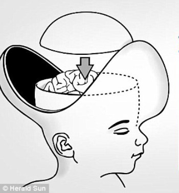Kinh ngạc về ca phẫu thuật tách hai bé gái dính liền đầu