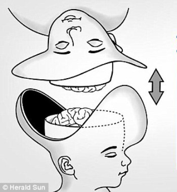 Kinh ngạc về ca phẫu thuật tách hai bé gái dính liền đầu