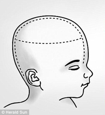 Kinh ngạc về ca phẫu thuật tách hai bé gái dính liền đầu