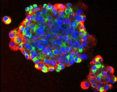 Tế bào gốc – hy vọng mới trị ung thư
