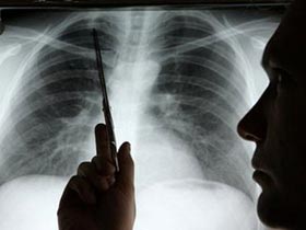 Liệu pháp xạ trị mới cho bệnh nhân ung thư phổi
