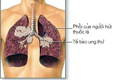 Xét nghiệm cảnh báo ung thư phổi ở người hút thuốc