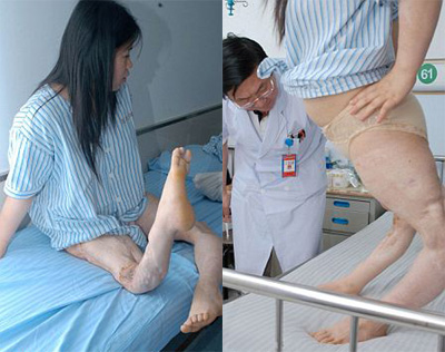 Cô gái có đôi chân cong kỳ lạ 
