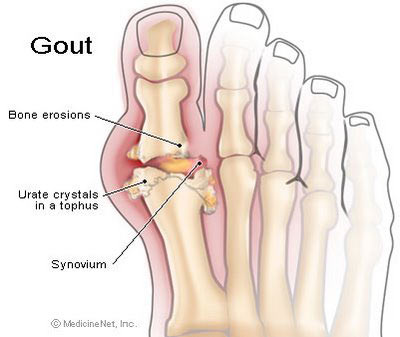 Đường Fructoza và bệnh gout, bệnh gan nhiễm mỡ