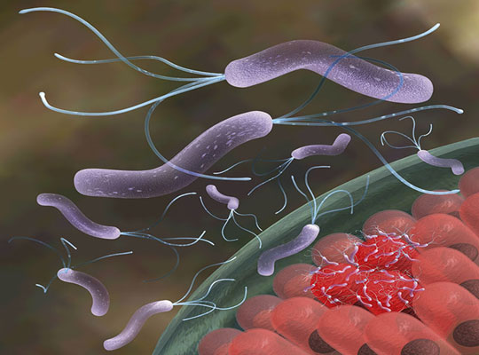 Vi khuẩn Helicobacter Pylori giúp ngăn bệnh suyễn