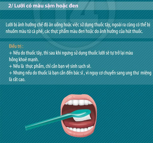 Ngó nghiêng chiếc lưỡi để đoán biết bệnh tật