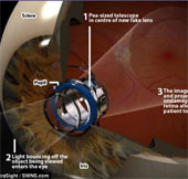 Đột phá kỹ thuật cấy kính viễn vọng trong mắt