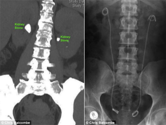 Hình ảnh vị trí các viên sỏi trước khi điều trị (trái) và cơ thể bệnh nhân đã hết sỏi (phải). Phương pháp mới cho phép tán sỏi ở hai thận cùng lúc