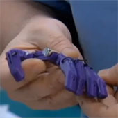 Tạo ngón tay giả từ máy in 3D