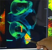 Phát triển công nghệ chụp não cho bệnh nhân cấy ghép ốc tai