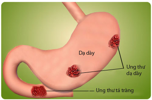 6 điều quan trọng về viêm loét dạ dày ai cũng cần biết