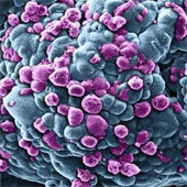Các nhà khoa học Italy tìm ra cơ chế di căn ở bệnh ung thư vú