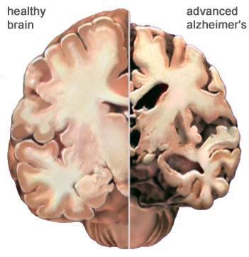 Vì sao phụ nữ mắc bệnh Alzheimer nhiều hơn nam giới?