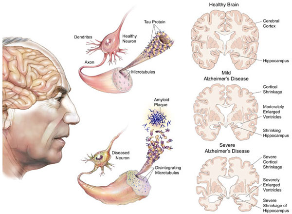 Vì sao phụ nữ mắc bệnh Alzheimer nhiều hơn nam giới?