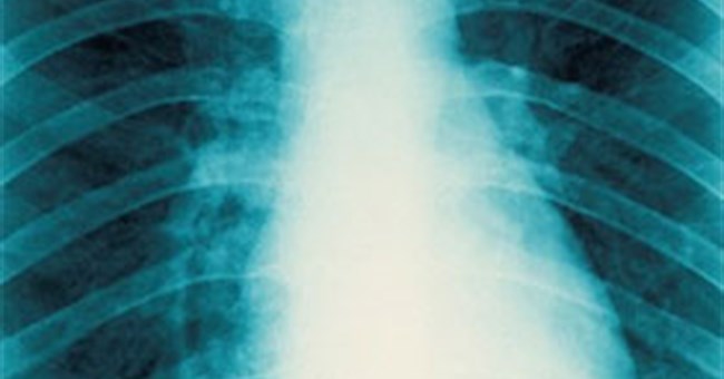 Tìm hiểu cơ chế tự tái tạo xương ngay trong cơ thể