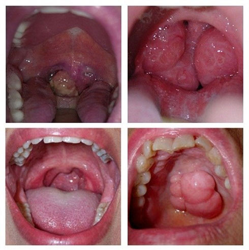 Những hiểu biết cần có về ung thư vòm họng