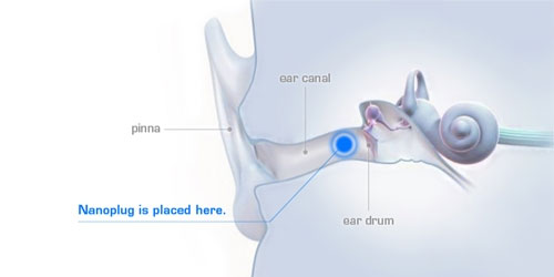 Thiết bị trợ thính nhỏ nhất thế giới
