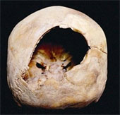 Phẫu thuật não có thể diễn ra cách đây 3.000 năm