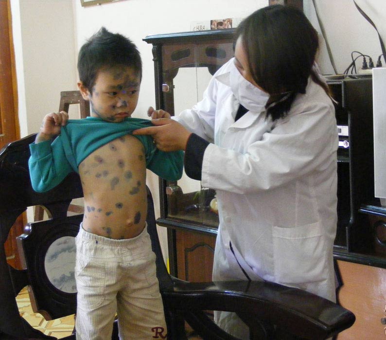 Phòng ngừa bệnh thủy đậu