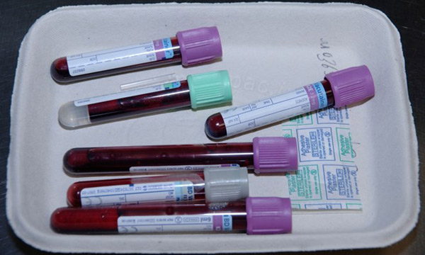 Phát hiện ung thư buồng trứng sớm nhờ thử máu thường xuyên