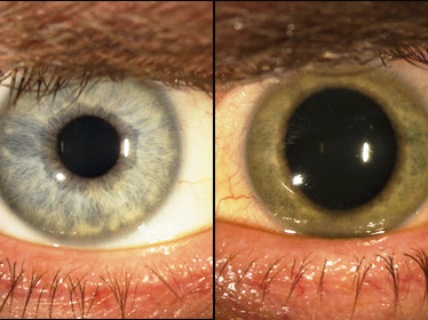 Mắt bị đổi màu sau khi chữa khỏi Ebola