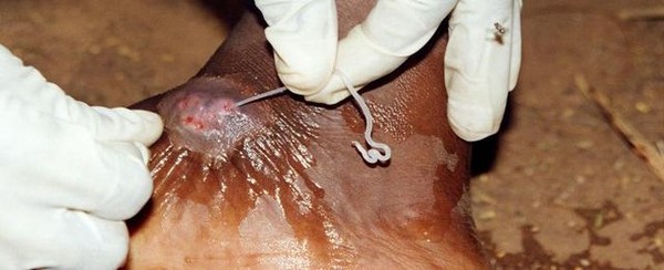 Kinh dị những loài sâu bọ gây biến dạng cơ thể con người