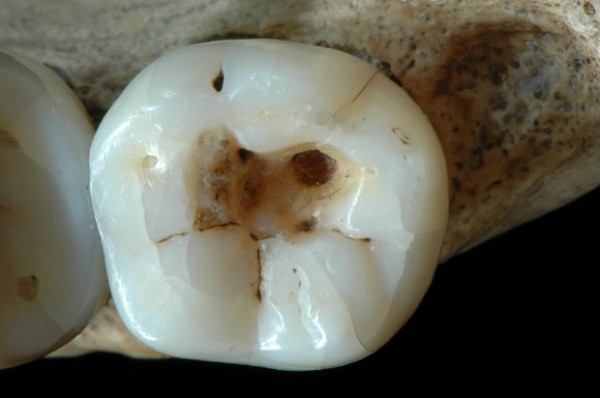 Tìm ra phương pháp chữa răng của người cổ đại