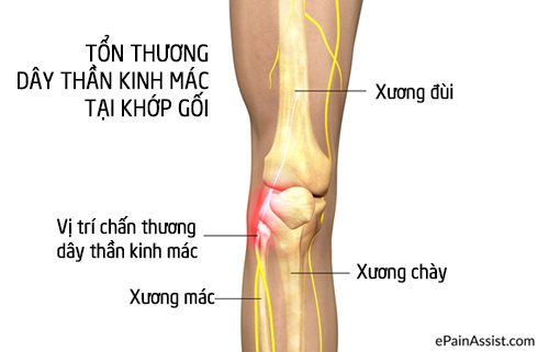 Mối hại không ngờ của thói quen ngồi vắt chéo chân