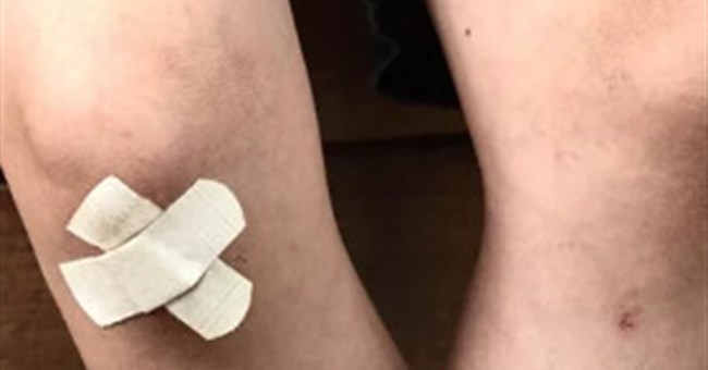 Băng y tế có khả năng làm lành vết thương bằng cách... hút vi khuẩn