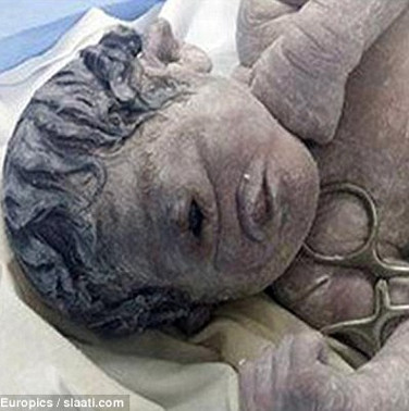 Chuyện lạ: Bé trai một mắt chào đời ở Ai Cập