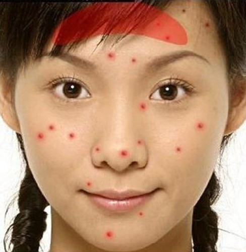 16 vị trí của mụn cảnh báo về sức khỏe