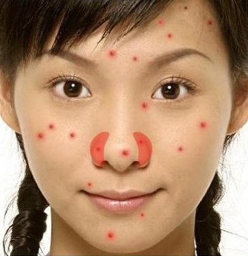 16 vị trí của mụn cảnh báo về sức khỏe