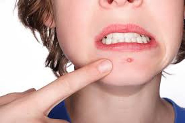 16 vị trí của mụn cảnh báo về sức khỏe