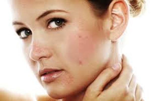 16 vị trí của mụn cảnh báo về sức khỏe