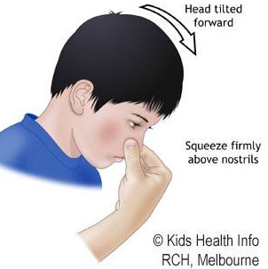 Xử trí khi trẻ chảy máu mũi