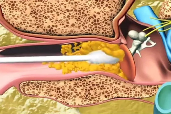 Sau khi xem bức hình này, đảm bảo bạn sẽ không dám ngoáy tai nữa