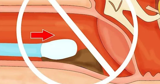 Sau khi xem bức hình này, đảm bảo bạn sẽ không dám ngoáy tai nữa