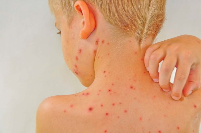 Lupus ban đỏ - Căn bệnh nguy hiểm ít được biết đến