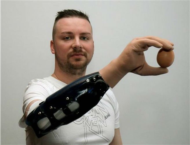 Bệnh nhân sử dụng cánh tay giả để cầm trứng. 