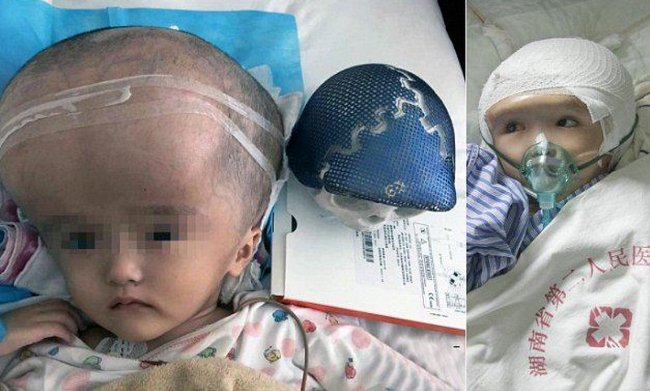 Bé gái Han Han là bệnh nhi đầu tiên bị não úng thủy được ghép thành công hộp sọ 3D.