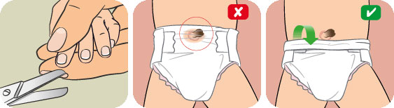 Chăm sóc rốn cho trẻ sơ sinh