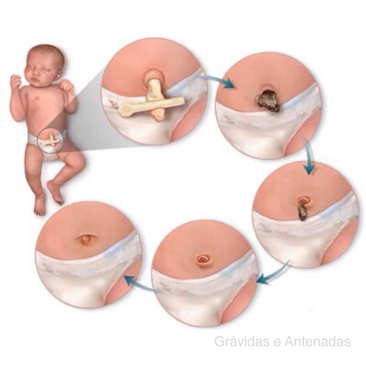 Chăm sóc rốn cho trẻ sơ sinh
