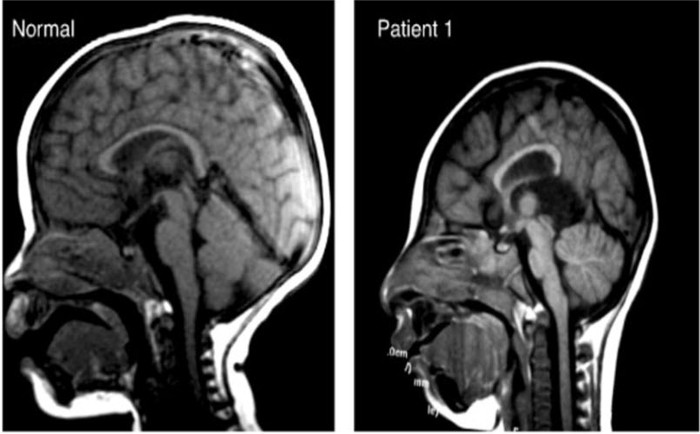 Virus Zika không gây ảnh hưởng lớn ở người trưởng thành nhưng đặc biệt nguy hiểm với phụ nữ mang thai vì có khả năng gây teo não ở trẻ.