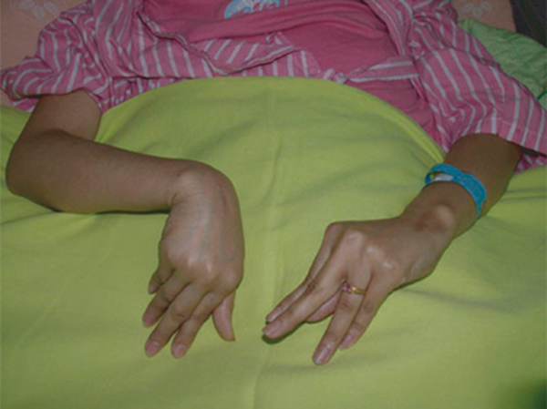 Co rút bàn tay (dấu hiệu Trousseau/bàn tay đỡ đẻ) trong hạ canxi máu.