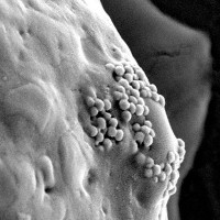 Hạt nano vàng phát nổ có thể tiêu diệt tận gốc tế bào ung thư