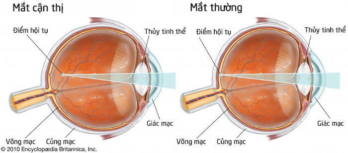 Một nửa dân số thế giới sẽ mắc cận thị vào năm 2050