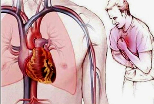 Cách xử trí khi có cơn đau thắt ngực